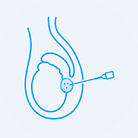 Drenagem de abscesso – Epidídimo